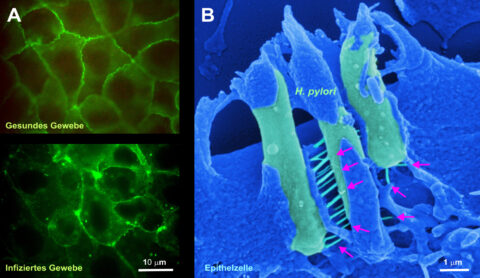 ((A) Healthy epithelial tissue compared with infected epithelial tissue (green) in the human stomach destroyed by Helicobacter pylori. (B) Three magnified bacteria (light green) viewed under an electron microscope. Red arrows indicate the protruding ‘toxin needles’ through which, ultimately, cancer can be induced. (Images: A FAU/Prof. Steffen Backert, Aileen Harrer; B: Prof. Manfred Rohde (HZI, Braunschweig))
